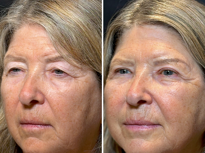Blepharoplasty before and after