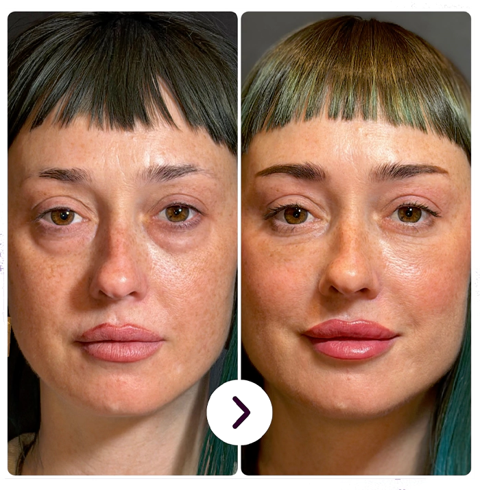 Blepharoplasty before and after