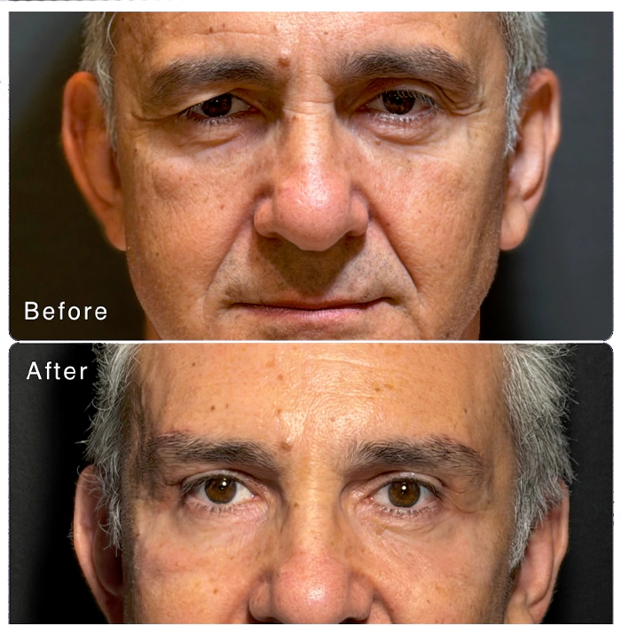 Blepharoplasty before and after