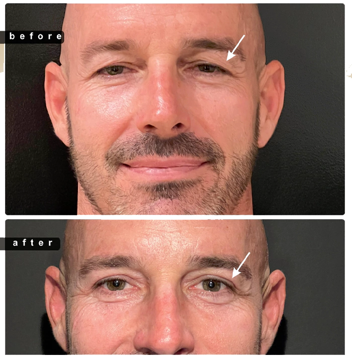 Blepharoplasty before and after
