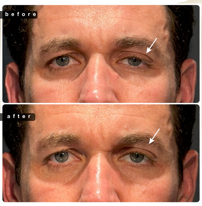 Blepharoplasty before and after