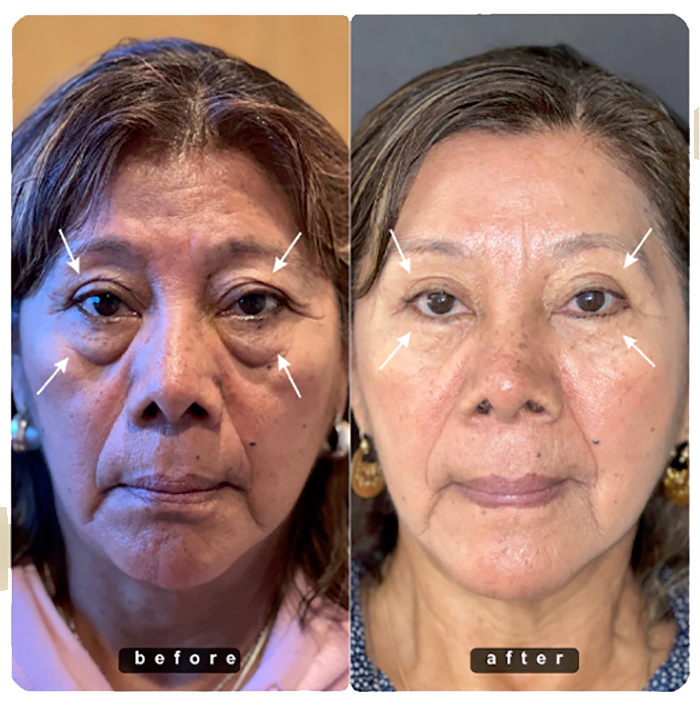 Blepharoplasty before and after