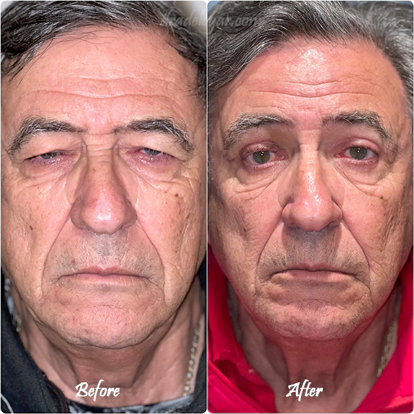 Upper blepharoplasty before and after