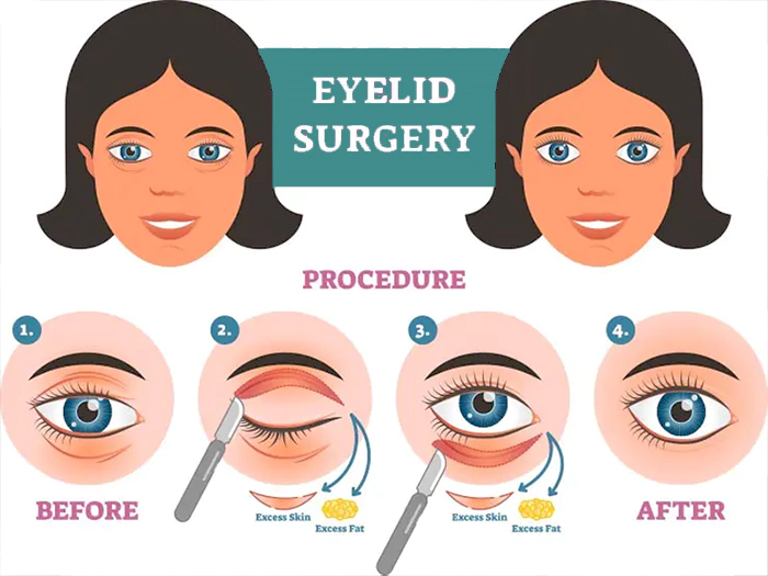 Stages of Eyelid Surgery