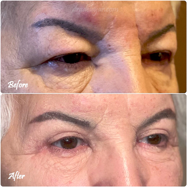Upper blepharoplasty before and after