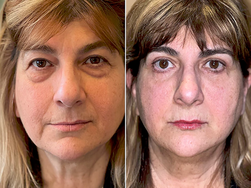 lower blepharoplasty
