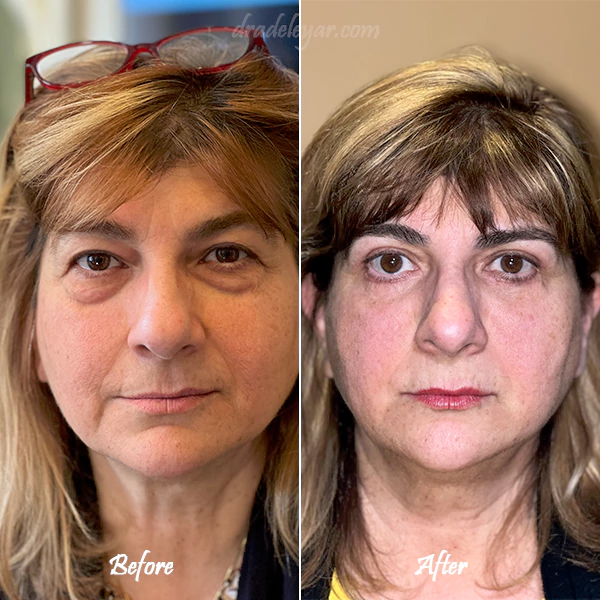 lower blephoroplasty before and after